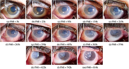 Postmortem_changes_of_the_eye